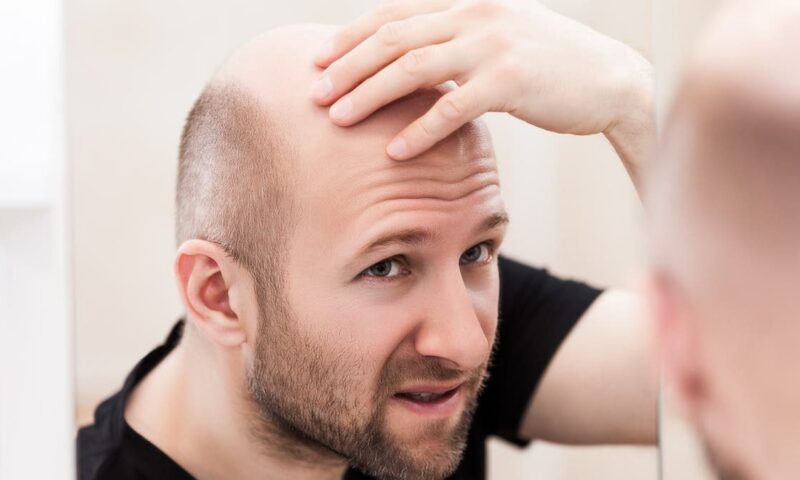 ما سبب الصلع عند الرجال .. اكتشف السر