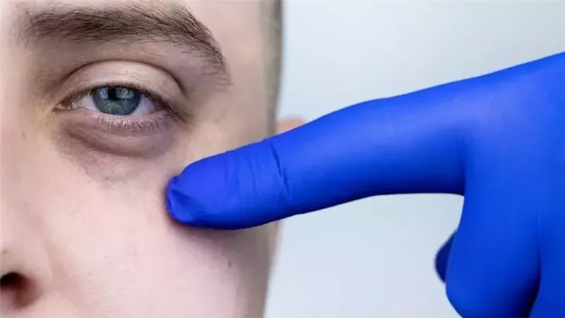 وصفة طبيعية للتخفيف من انتفاخ أسفل العينين