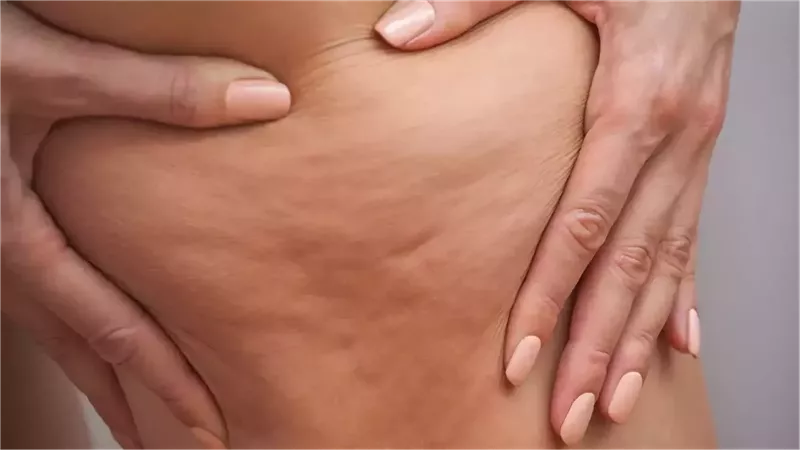 5 علامات تدل على أنك مصابة بالليبيديما وليس سيلوليت