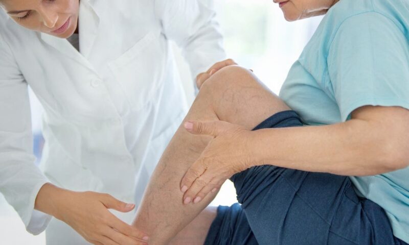 دوالي الساقين.. النساء أكثر إصابة وهذه علامات الخطر