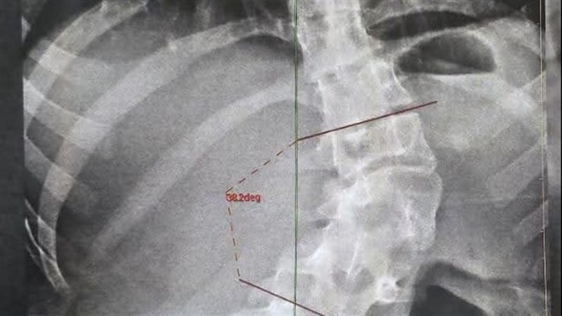 تصحيح شبه كامل لتشوهات العمود الفقري، نجاح جراحة دقيقة لفتاة بمستشفيات بنها الجامعية