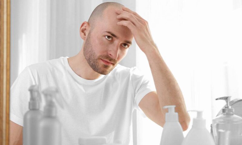 قبل شعرك ما يقع خالص.. إليك علاج الصلع عند الرجال