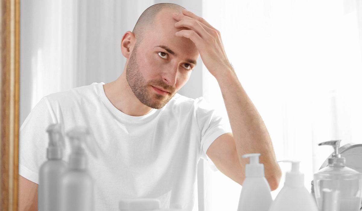قبل شعرك ما يقع خالص.. إليك علاج الصلع عند الرجال
