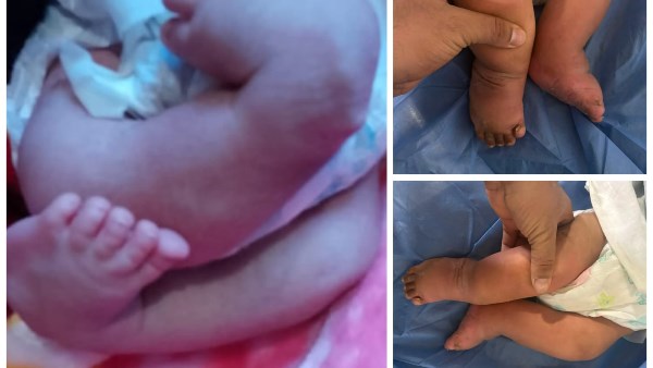 فريق طبي بجامعة أسيوط ينقذ رضيعًا عمره 4 أشهر من تشوه نادر