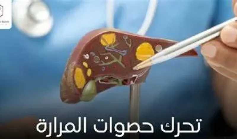 علاجات حصوات المرارة:  متى تكفي الأدوية ومتى تصبح الجراحة الحل الأفضل؟