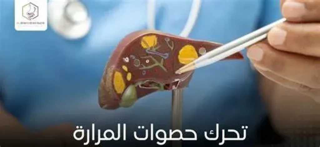 علاجات حصوات المرارة:  متى تكفي الأدوية ومتى تصبح الجراحة الحل الأفضل؟