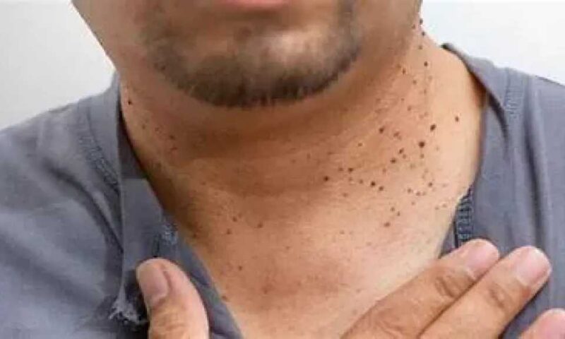 أسباب الزوائد الجلدية : متى تكون طبيعية ومتى تستدعي زيارة الطبيب؟