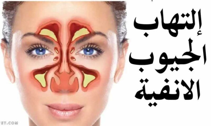 لا تتجاهل التهاب الجيوب الأنفية : أعراض بسيطة قد تخفي مضاعفات خطيرة تستدعي العلاج
