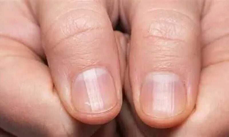 علامات تظهر على اليدين والأظافر قد تكشف أمراض الكبد مبكرًا : لا تتجاهلها