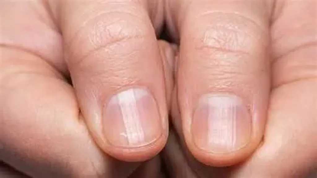 علامات تظهر على اليدين والأظافر قد تكشف أمراض الكبد مبكرًا : لا تتجاهلها