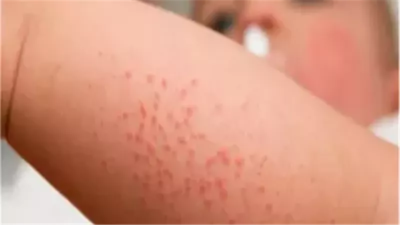 أسباب وأعراض حمو النيل عند الأطفال في الصيف