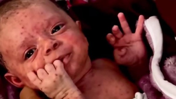 جدري الماء يضرب مخيمات غزة.. نقص اللقاحات يحول المرض إلى قنبلة صحية