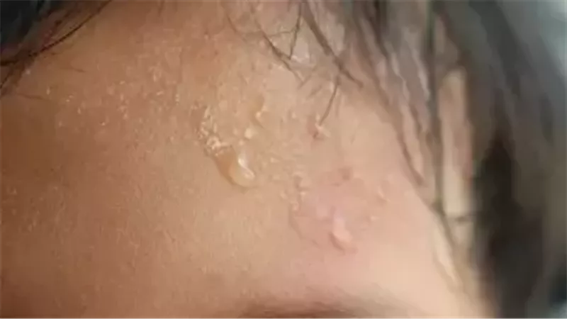 التعرق المفرط لدى الأطفال متى يجب مراجعة الطبيب؟