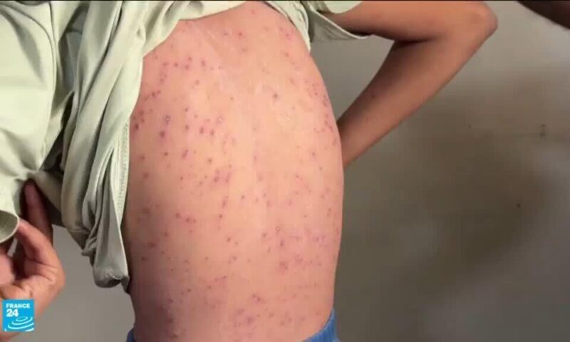 جدري الماء يفتك بأطفال النازحين في غزة وسط تدهور الأوضاع الصحية