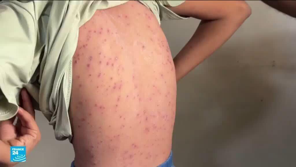 جدري الماء يفتك بأطفال النازحين في غزة وسط تدهور الأوضاع الصحية