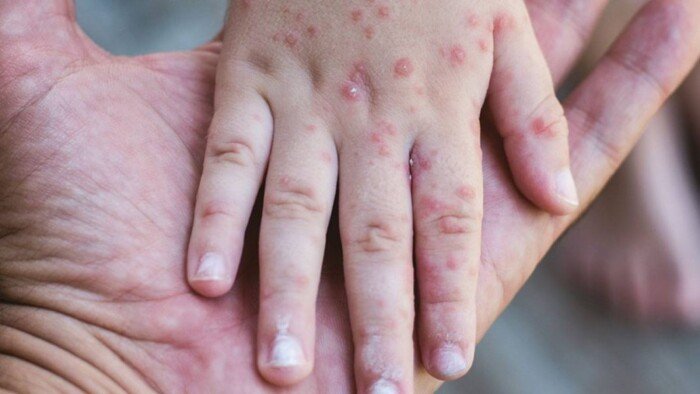 بنجلاديش تواجه تهديدا مزدوجا.. تفشي الحصبة وتحذيرات من تصاعد حمى الضنك