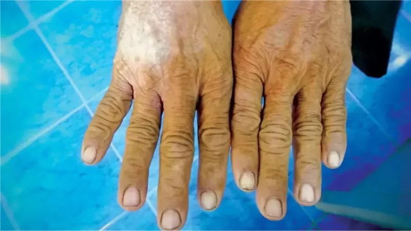 أعراض تصلب الجلد المناعي وأسباب الإصابة به وطرق العلاج