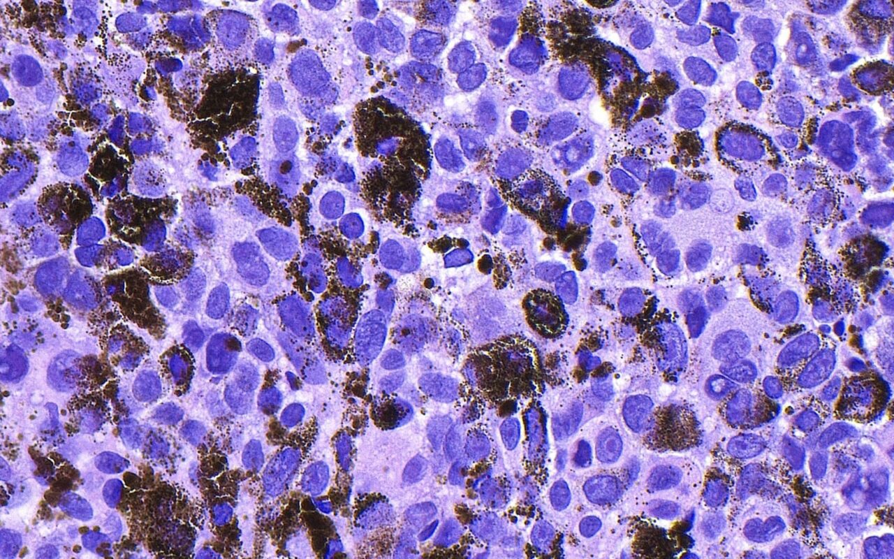 لقاح mRNA لعلاج سرطان الجلد ينجح في المرحلة الثالثة.. وسهم “مودرنا” يقفز 160%