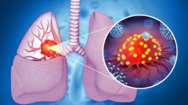 اليوم العالمي لسرطان الرئة.. دراسة تربط بين حالة دم خفية وارتفاع مخاطر تلوث الهواء