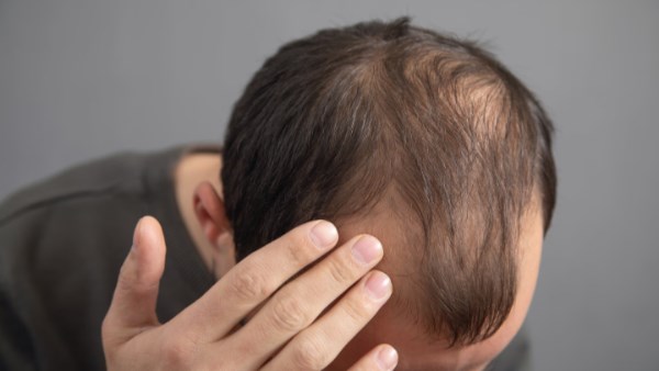 دواء لالتهاب المفاصل يساعد في علاج الثعلبة.. نتائج واعدة خلال 6 أشهر