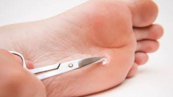 3 طرق طبيعية للتعامل مع عين السمكة في المنزل.. ونصائح للوقاية منها