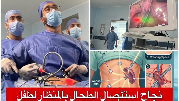 جامعة قناة السويس: استئصال طحال بالمنظار لطفل يعاني من تكور كرات الدم الحمراء