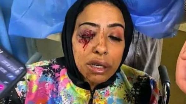 فقدت عينها اليمنى.. الاعتداء على موظفة بشركة تمويل مشروعات خلال تحصيل الأقساط في دمياط