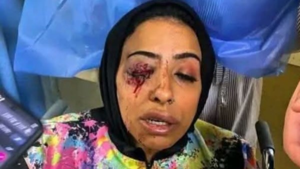 فقدت عينها اليمنى.. موظفة شركة تمويل مشروعات تفقد بصرها خلال تحصيل الأقساط