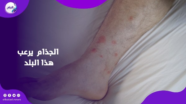 الجذام يعود ويرعـ. ب هذا البلد.. وتحذير من حيوان ينشر المرض