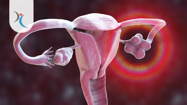 أعراض تكيس المبايض.. 10 علامات خطيرة لا تتجاهليها