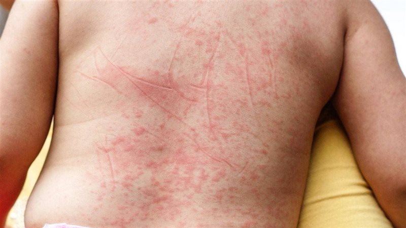 أسباب وأعراض الحمى الوردية عند الأطفال وطرق علاجها