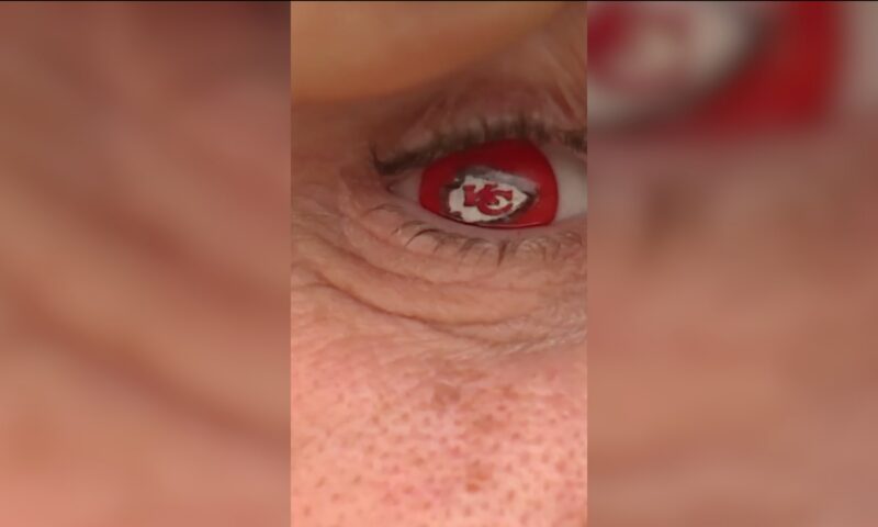 بعد إصابة بالغة في عينه.. عين اصطناعية بشعار فريقه المفضل