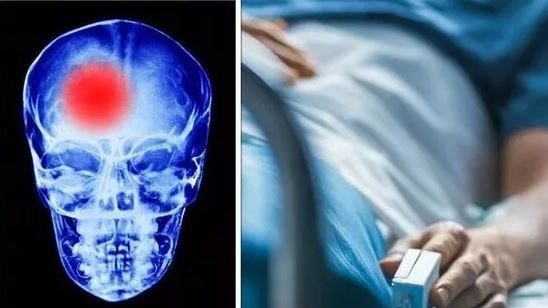 جلطة المخ مقابل النوبة القلبية.. أيهما أخطر على الإنسان؟