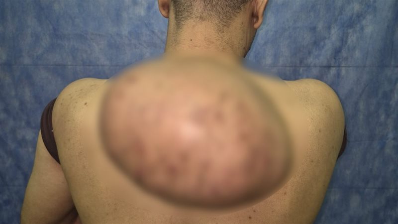 مستشفيات سوهاج الجامعية تنجح في استئصال ورم دهني ضخم يزن 15 كيلو