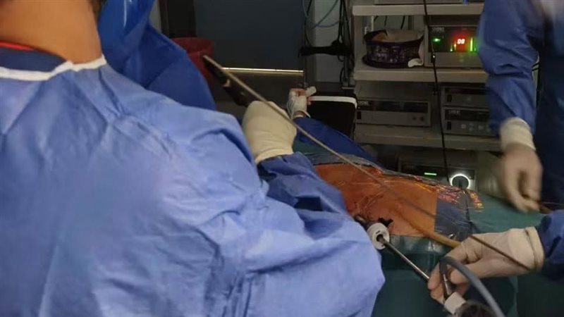 لأول مرة بجامعة كفر الشيخ، استئصال الغدة الثيموسية بالكامل بالمنظار لمريض مصاب بوهن العضلات
