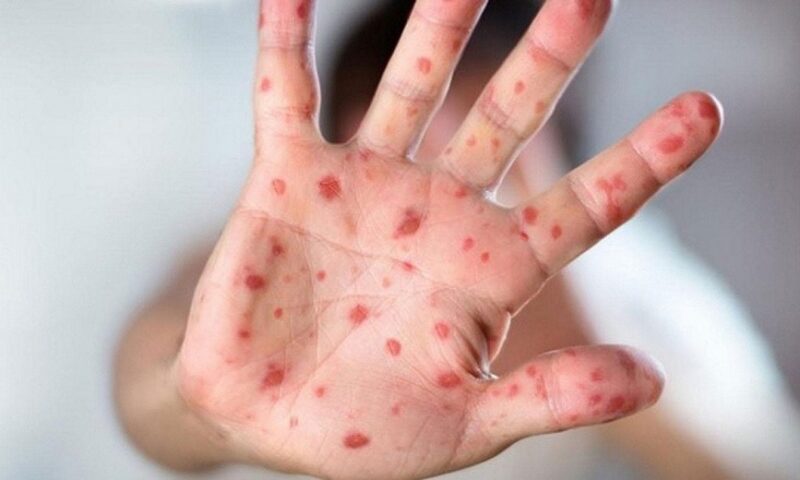 الانتشار مستمر.. الصحة العالمية تكشف مفاجأة بشأن فيروس جدري القرود