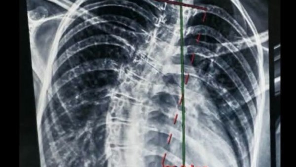استعدال كامل لعمود فقري لطفل 14 عامًا في جراحة دقيقة بمستشفيات جامعة بنها