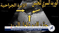 أربعةجلسات لنقل الدم داخل الرحم تنقذ جنينا من أنيميا حادة بمستشفى صحة المرأة بجامعة أسيوط