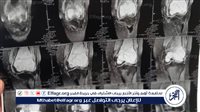 فريق طبي بجامعة أسيوط ينجح في استئصال ورم أسفل الفخذ لشابة وتركيب مفصل صناعي