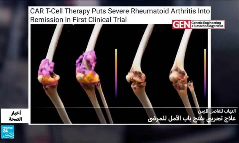 التهاب المفاصل المزمن.. علاج تجريبي يفتح باب الأمل للمرضى
