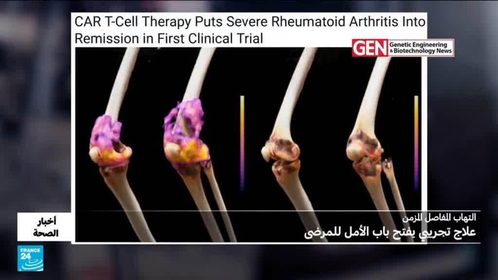 التهاب المفاصل المزمن.. علاج تجريبي يفتح باب الأمل للمرضى