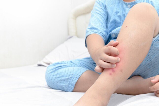 لدغات القراد عند الأطفال.. 6 طرق صحية للوقاية