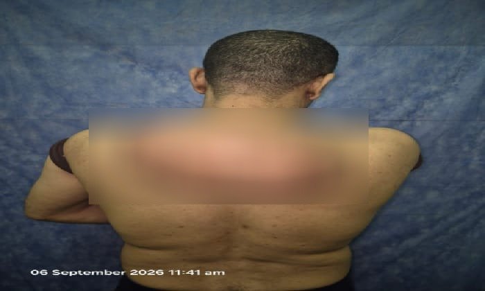 بوزن 15 كجم.. مستشفيات سوهاج الجامعي تنجح في استئصال ورم دهني ضخم