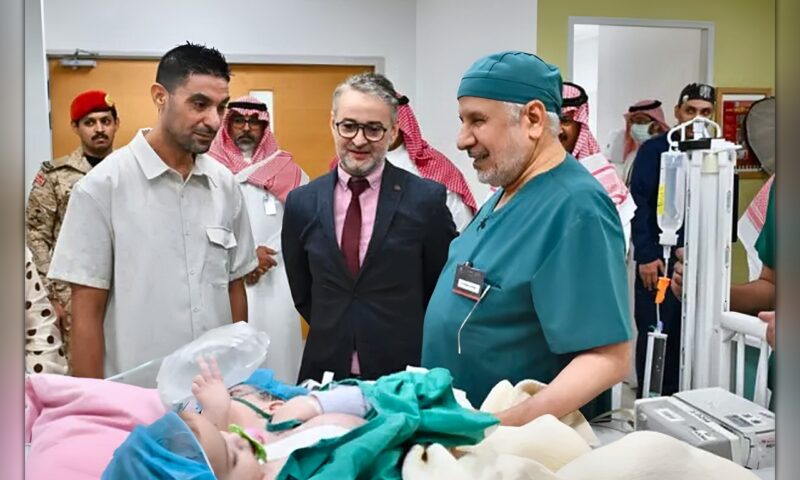 نجاح عملية فصل التوأم الملتصق المغربي «سجى وضحى»
