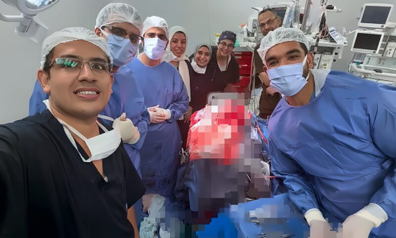 أطباء قصر العيني ينجحون في إنقاذ مريض باستخراج مسمار من الجمجمة بالقرب من شرايين المخ