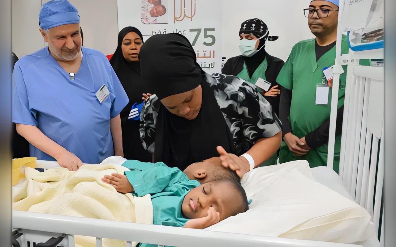 بدء عملية فصل التوأم الملتصق التنزاني «لايتيينس ولوفنس»