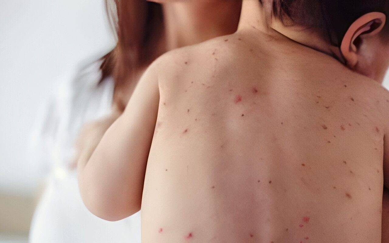 الصحة: تطعيمات الحصبة مجانًا للأطفال من عمر 9 شهور حتى 10 سنوات