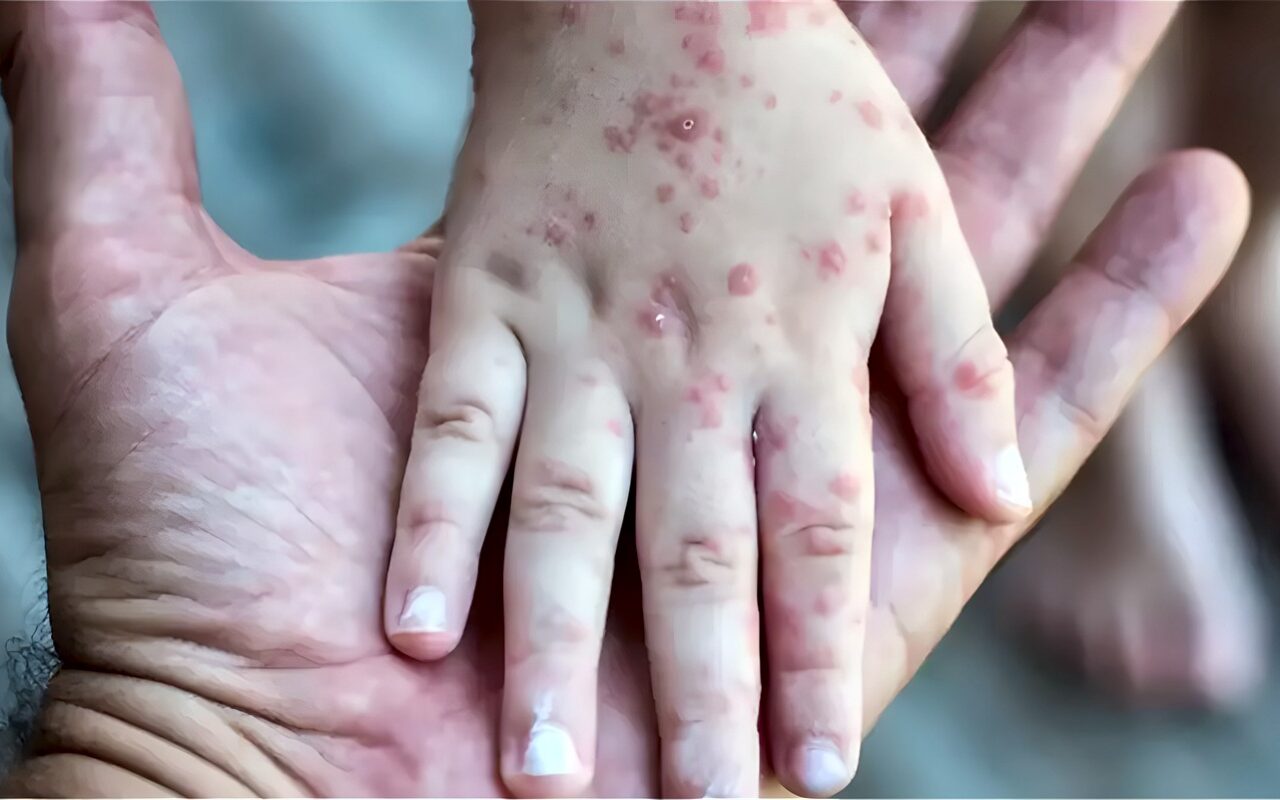 الصحة توضح أعراض الحصبة وطرق العدوى وتحذر من ذهاب الطفل المصاب إلى المدرسة
