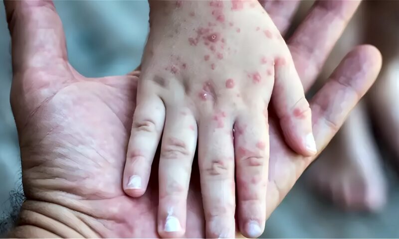 الصحة توضح أعراض الحصبة وطرق العدوى وتحذر من ذهاب الطفل المصاب إلى المدرسة