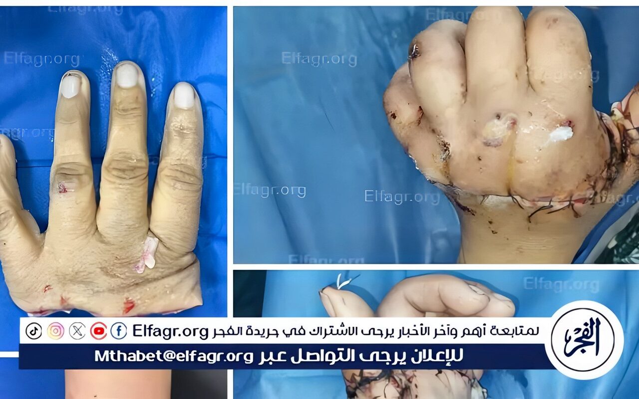 فريق طبي بجامعة أسيوط ينجح في إعادة توصيل الأصابع الأربعة للمريضة بجراحات ميكروسكوبية دقيقة